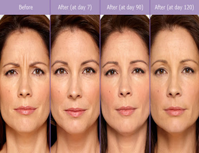 5 мл кожных наполнителей для лица PLLA коллаген Derma Filler для инъекций