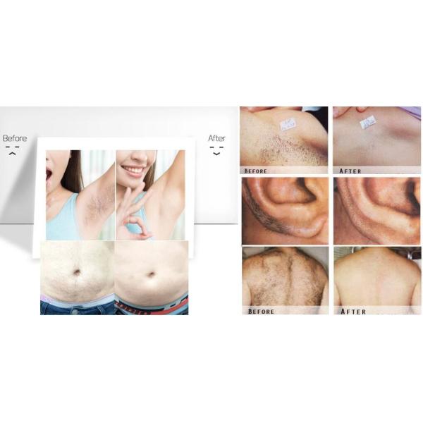 машина удаления волос лазера диода 808nm салона красоты 1Hz умная