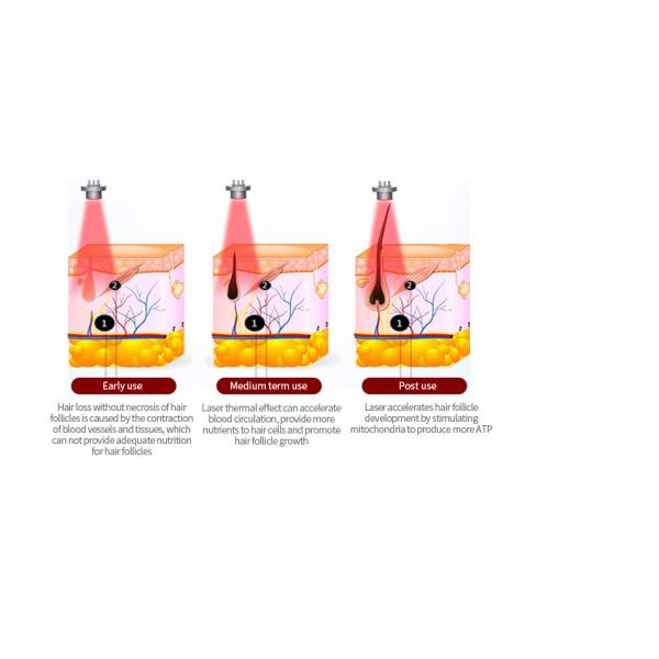 Вертикальный гребень роста волос лазера машины 650nm терапией света СИД PDT