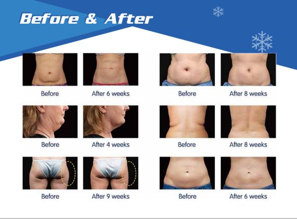 cryolipolysis slimming machine, fat freeze weight loss, 5 handles,  China manufacturer, USA hot,