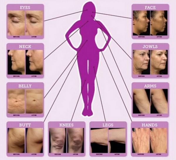 Most Popular CE Approved fractional microneedle rf for Acne Scars removal