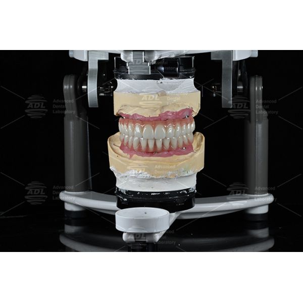 China Dental Lab Fast Turnaround Time In 72 Hours Provides High Quality All on X