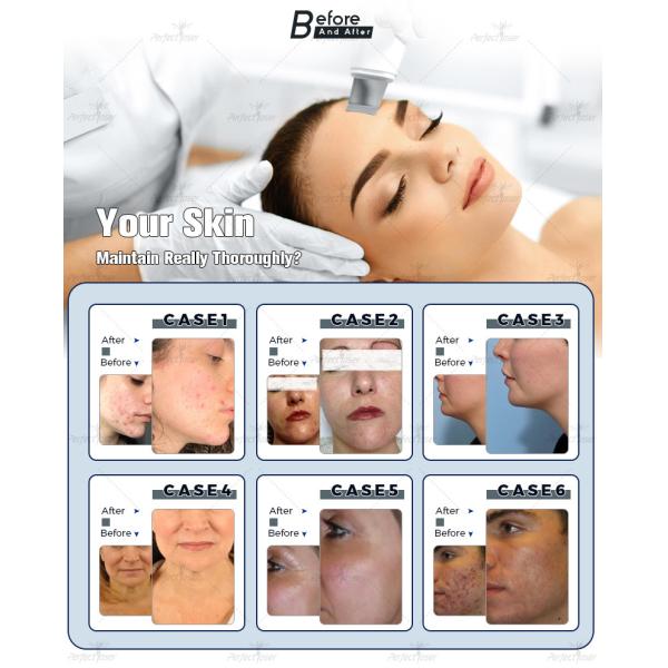 13 в 1 приборе Дермабразион машины 250ВА гидрофациал корки двигателя кислорода воды