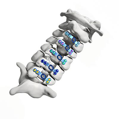 6mm - 16mm Laminoplasty Plate Cervical Spine Open Door Plate Titanium Alloy