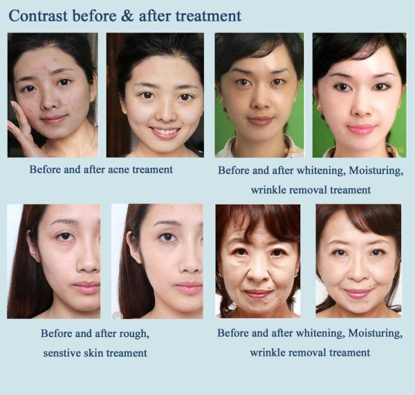 Skin Beauty Water Mesotherapy Equipment Vacuum Injection HIFU