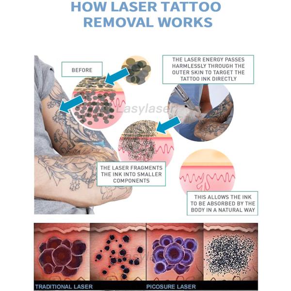 Home Use Tattoo Laser Removal Machine Fungal Remover Onychomycosis Cure