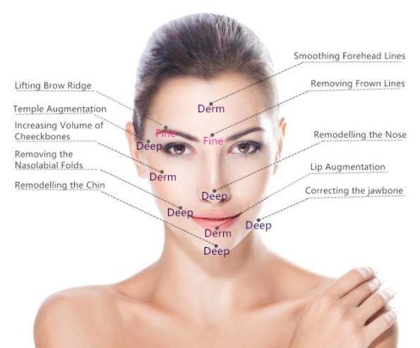 La cruz cutánea del llenador de Fosyderm ligó la inyección ácida hialurónica 24mg/Ml de los labios del gel para la pluma de Hyaluron