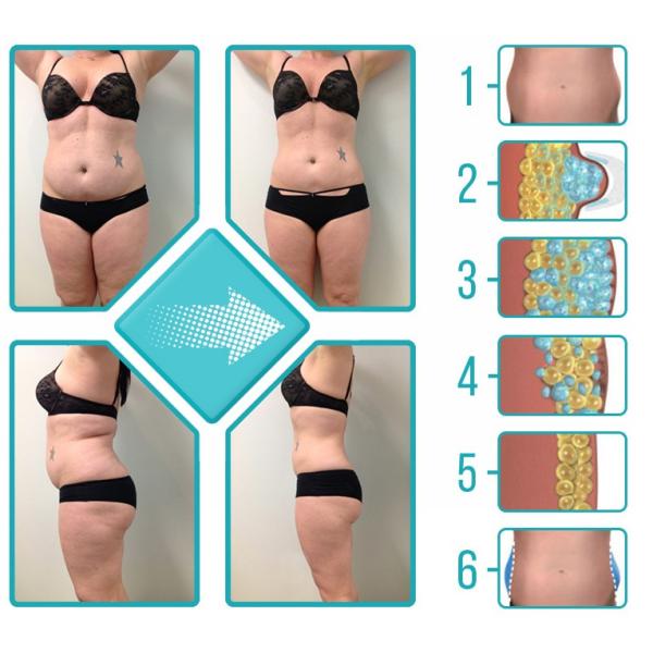 Portable Cryolipolysis Cavitation Rf Lipolaser Slimming Coolsculpting Machine 1000W