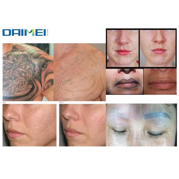 Portable Q Switched Nd Yag Laser Tattoo Removal Machine , Pigment Removal Machine