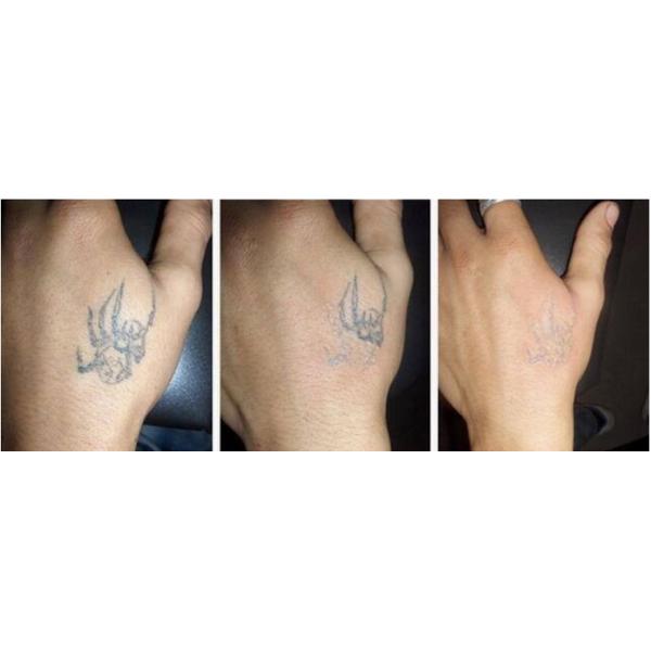 Stationary Q - Switched ND Yag Laser Tattoo Temoval Beauty Machine