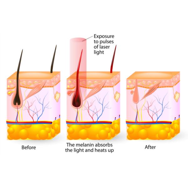 High Energy RF Elight IPL Laser Machine For Hair Removal / Freckle Removal