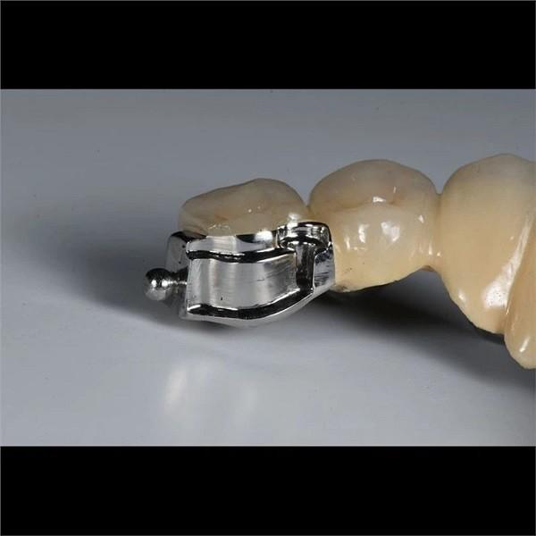 Aesthetic Precision Dental Implant Ball Attachment Partial Dentures