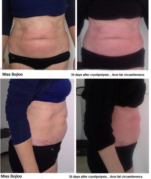 Body Weight Loss Sculpting Slimming Freeze Fat 4 handles cryolipolysis body slimming weight loss