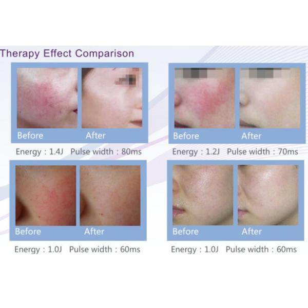 Blood Vessels Removal Diode Laser Beauty Machine Linear Anglitelectasis