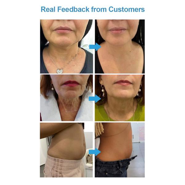 2023 Hot selling 7D Facial Lifting Anti-Wrinkle Beauty Salon Equipment