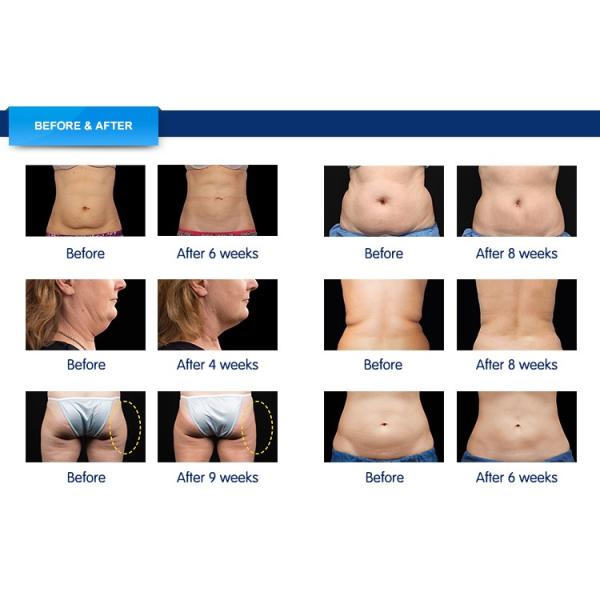 Beauty clinic used Coolsculpting body shape slimming machine cryolipolysis fat freezing device with RF cavitation