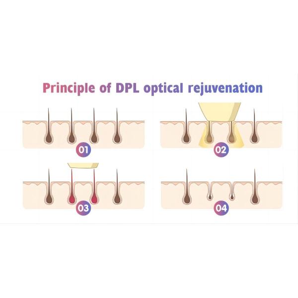 Dpl IPL Laser Hair Removal Equipment Cost High Quality Commercial Use OEM Aesthetics Painless Hair Removal Hot Sale Multifunctional Dpl+Elight+Sr Hr +Ipl + Rf Hair Removal Vascular Removal Ipl Dpl Skin Rejuvenation Machine