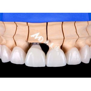 Biocompatible Titanium Alloy Base Dental Implant Crown Bridge with Natural-Looking Aesthetic