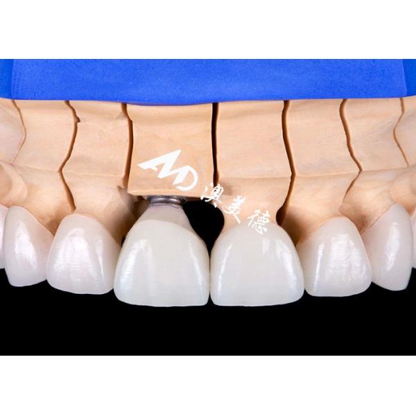 Biocompatible Titanium Alloy Base Dental Implant Crown Bridge with Natural-Looking Aesthetic