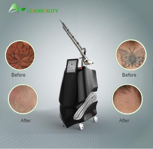 Tattoo removal birthmark removal PICO SURE Nd:YAG laser