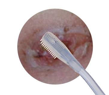 Medical Wound Irrigation Brush With Injection Port For Injecting Saline
