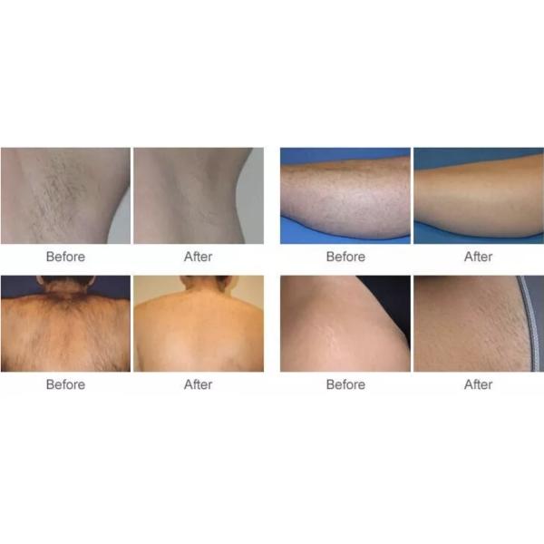 690mm Shr Ipl Laser Permanent Hair Removal System Single Pulse