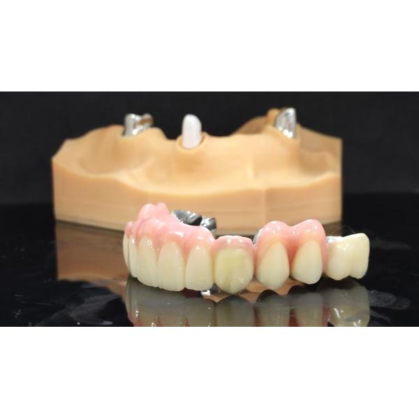 High Strength Titanium Crown And Bridge Coping With Composite