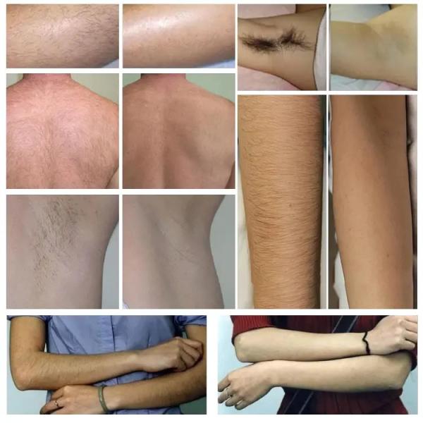 Most Sell Product 2 in 1 Picosecond Tattoo Removal Diode Hair Removal 755 808 1064 Nm Ice Hair Remove Machine