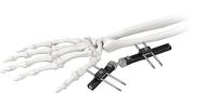 Fixateur extérieur de poignet orthopédique standard à un côté intégré