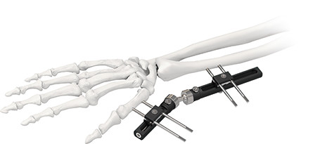 Ортопедический наружный фиксатор запястья стандартный односторонний интегрирован