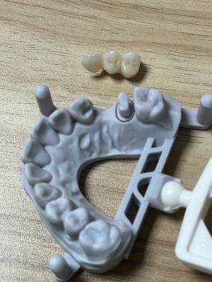 Maryland Bridge with CAD/CAM Digital Technology for Minimally Invasive Single