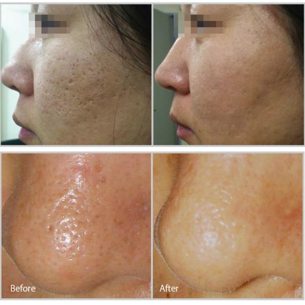 40W Fractional Vaginal Rejuvenation Machine Facial Whitening 10600nm Wavelength