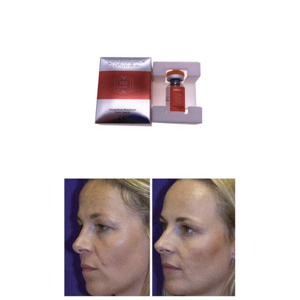 Botulinum тип впрыски Hyamely Botox 100IU токсина a сморщивает BTX впрыски удаления