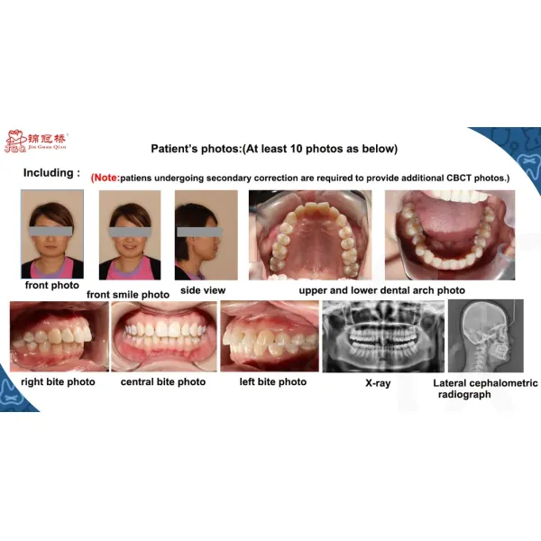 Personalized Customization Clear Aligners Precisely Fitting for Correct Teeth