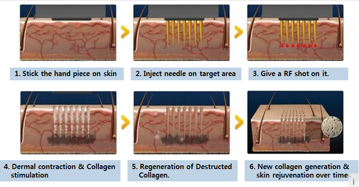 Combined e-light nd yag laser hair removal settings , skin care machine