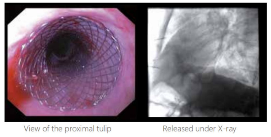 Медицинский покрытый и расчехленный Esophageal Stent имплантирует материалы & искусственные органы классифицируют II