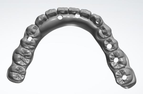 Digital Aluminum Bar with Temporary Teeth for Dental Study Models