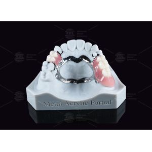 Dentadura parcial acrílica metálica removível com pinças para mastigar parcialmente
