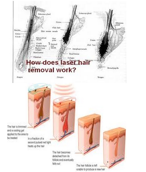 diode laser hair removal machine watt laser hair removal