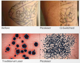 q switch nd:yag laser pico 1064nm/532nm ; 585nm/650nm/755nm Optional pico second q switched nd yag laser