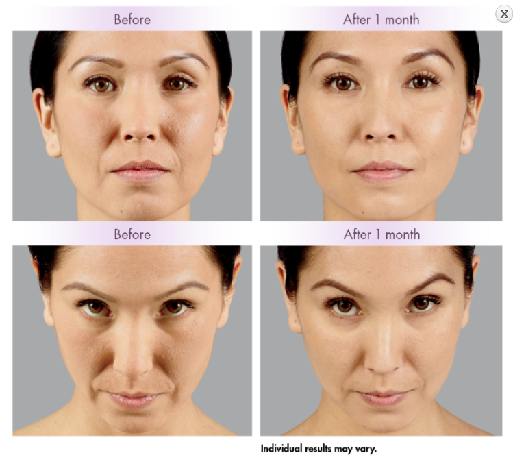 Впрыска Juvederm 2x1ml заполнитель 24mg/Ml ультра 3 губ дермальный