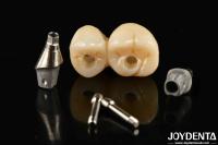 Implante dental de porcelana personalizable con puente y corona para una estética excepcional