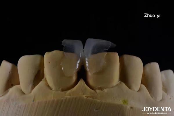 Minimally Invasive Cosmetic Dental Veneers Glass Ceramic Color ultra thin