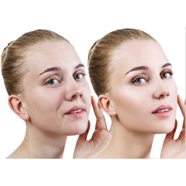 Arma coreano de Haifeel-S Mesotherapy para la piel paciente femenina y masculina original