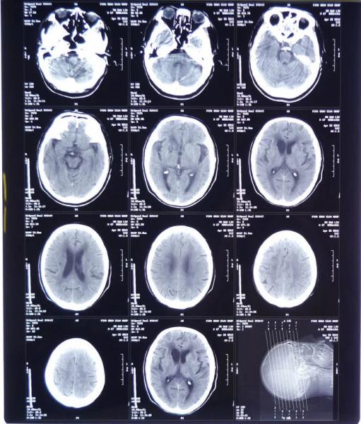 11X14 Inch Medical X-ray Film/Analogue Medical Film/Dry Film