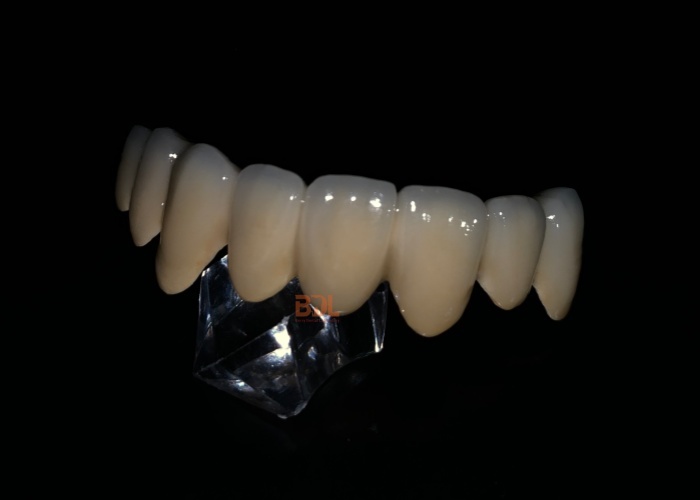 Durable Porcelain Fused To Metal Crown Dental Restoration Solution Ideal For Long Lasting Strength And Natural Appearance