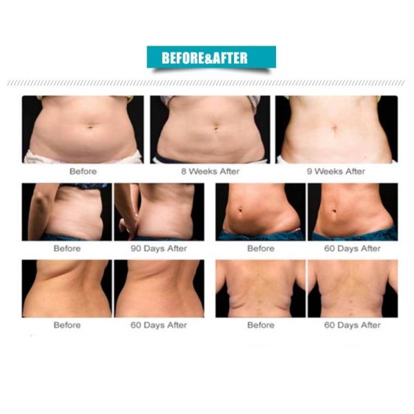 Electro Optical Vacuum 20Hz RF Beauty Equipment