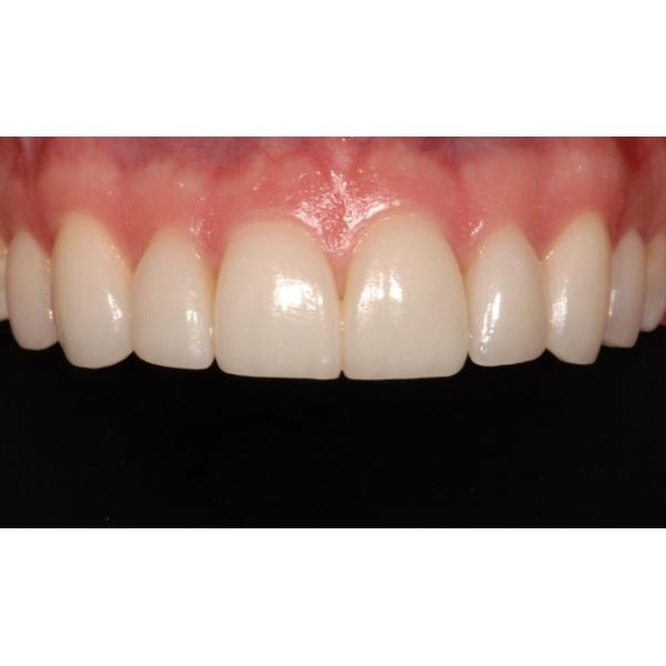 A2 98*18mm Multilayer Zirconia High Translucent Dental CE FDA Certificated