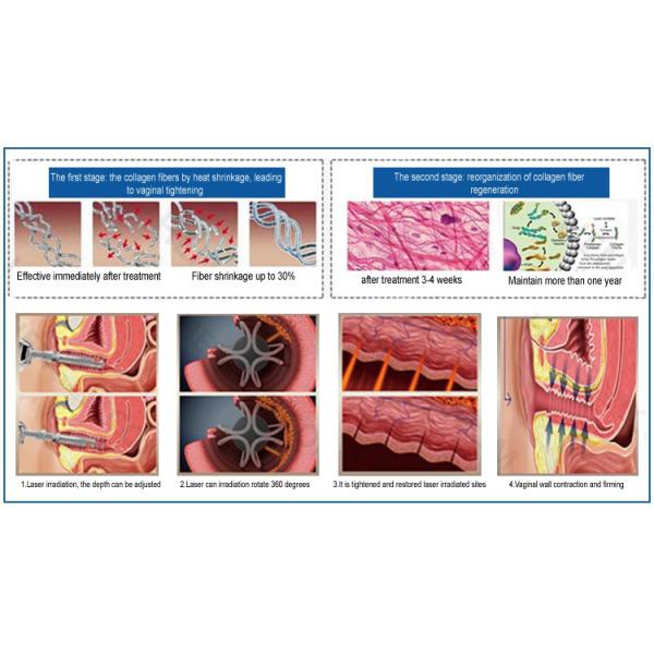 вертикаль удаления шрама угорь поры машины лазера коммерчески СО2 10600nm частичная