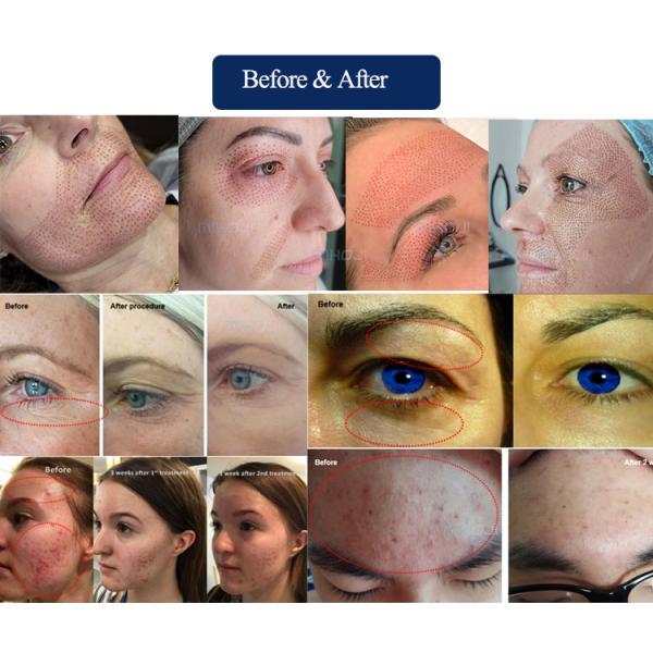 Профессиональный портативный холодный плазменный аппарат для ухода за кожей и противовоспалительных средств